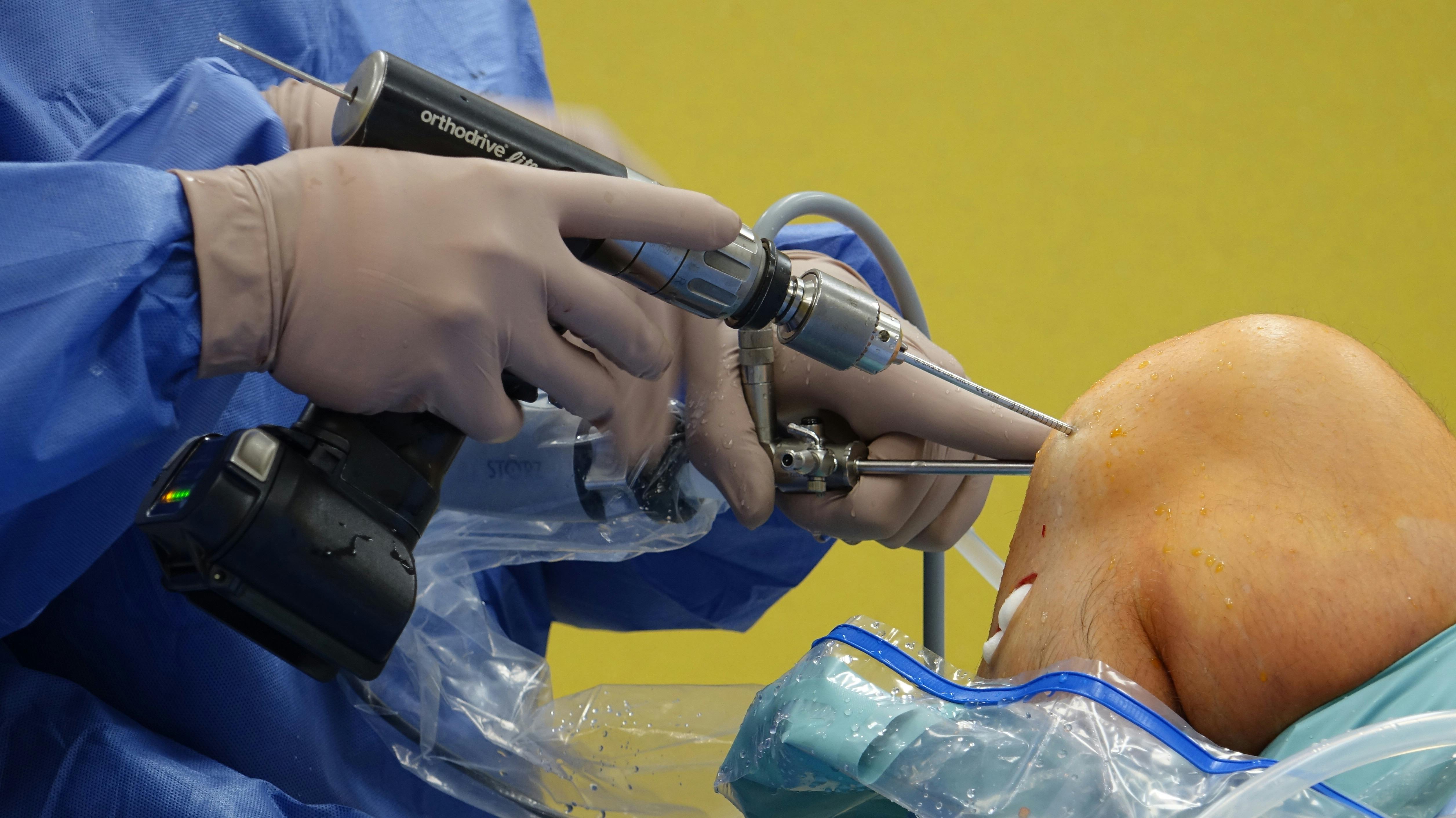 ArthroscopyLigament