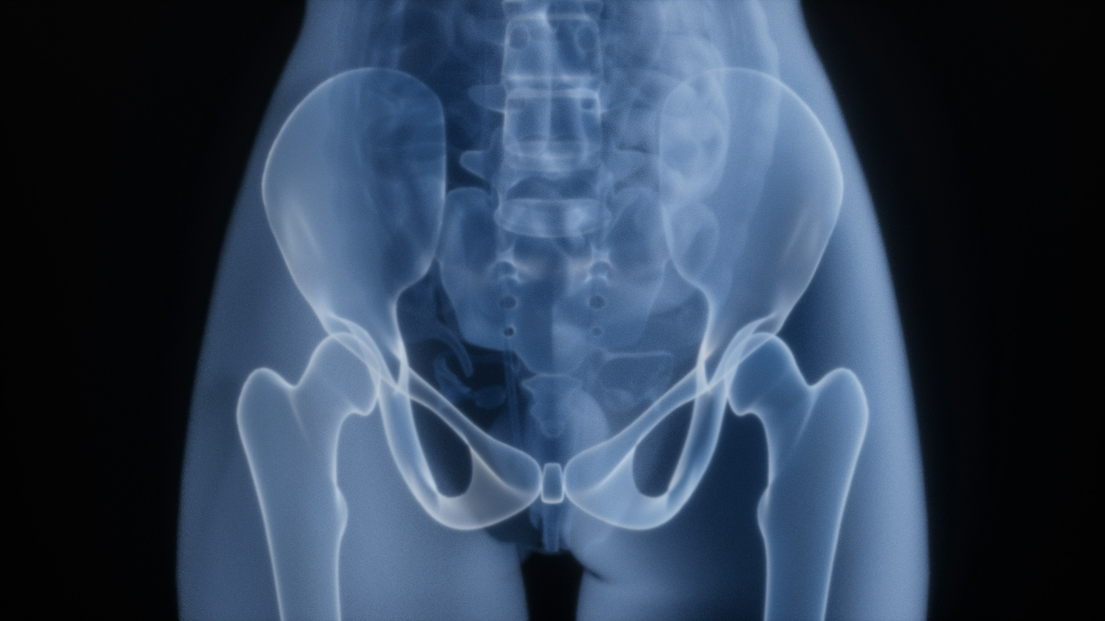 HipReplacement