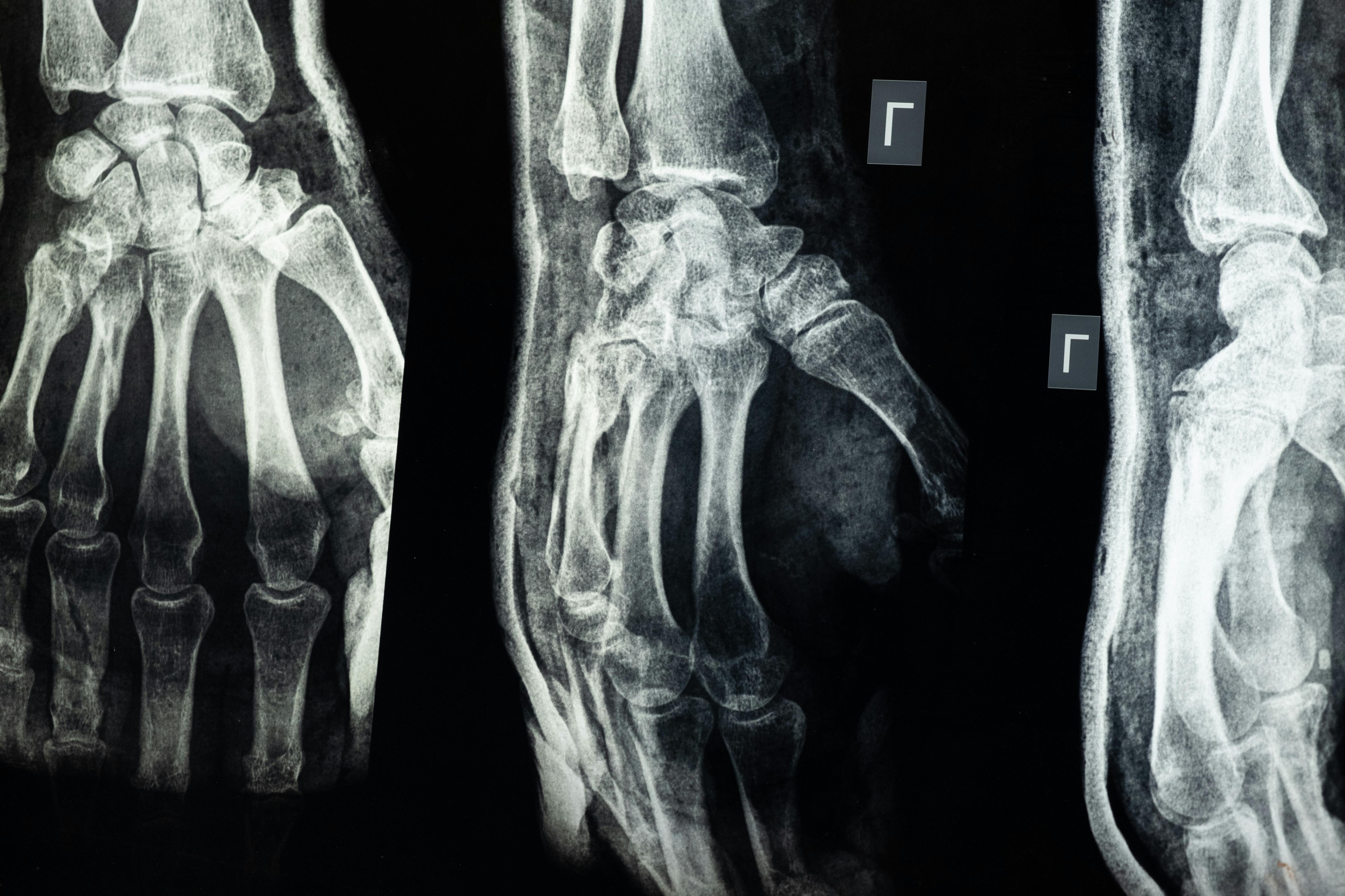TraumaFracture